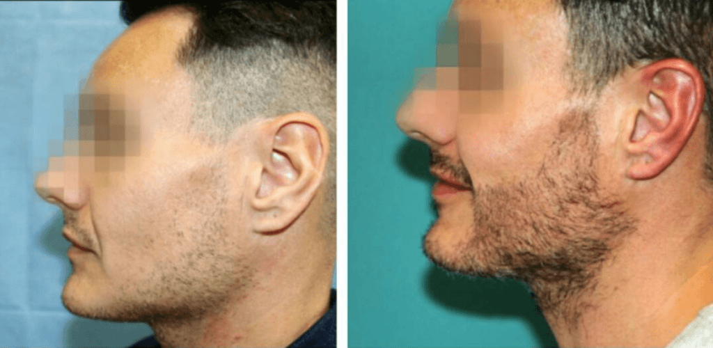 beard transplant before after