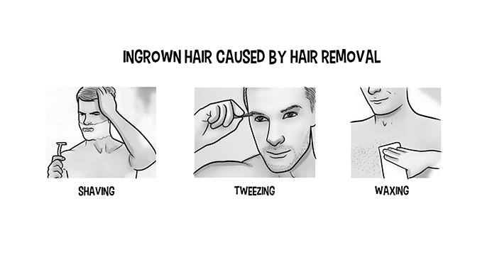 Ingrown Hair Caused By Hair Removal