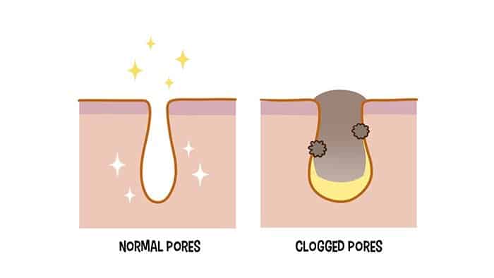 clogged pores