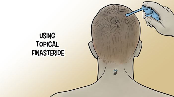 using finasteride