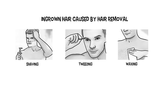 ingrown hair