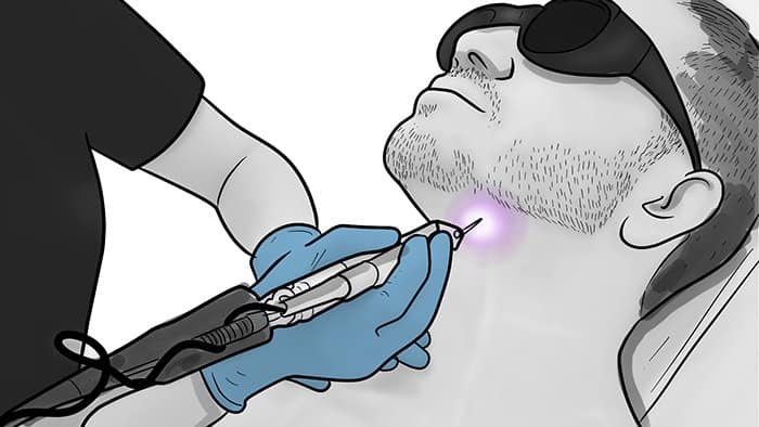 laser treatment