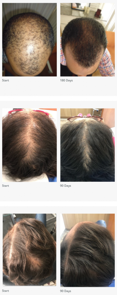 hair growth results