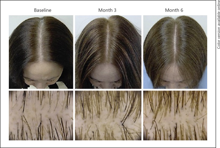 hair growth