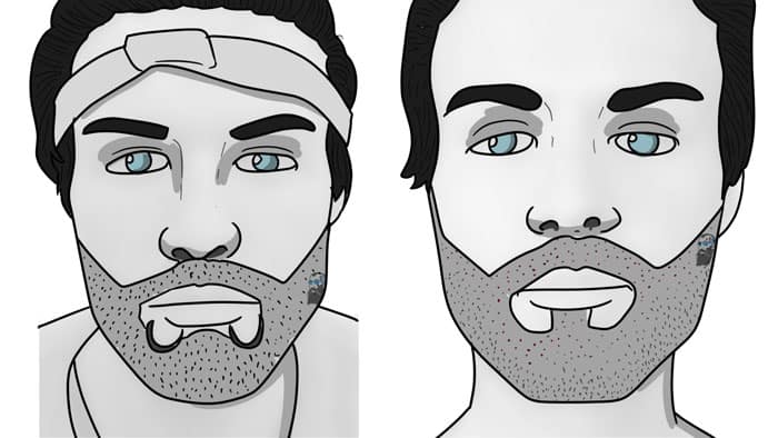 beard transplantation